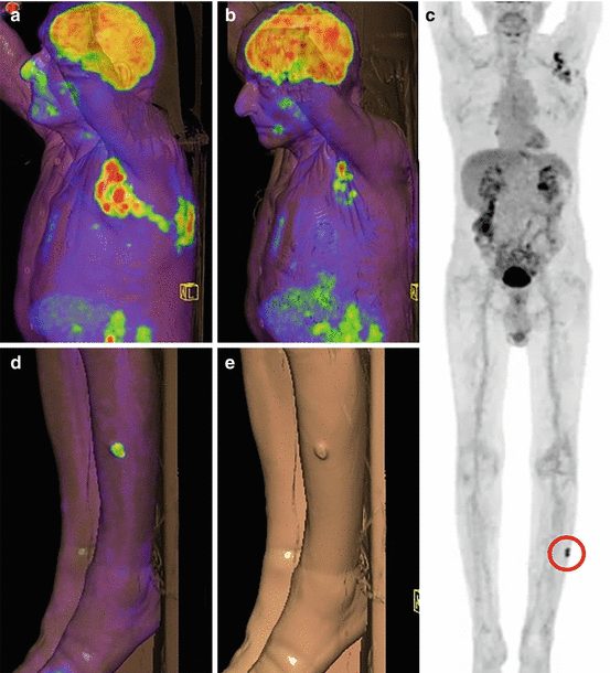 Role of PET/CT in Melanoma Radiology Key