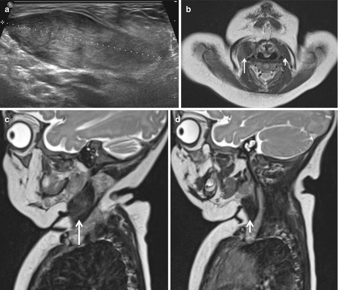 Imaging of Soft Tissue Tumors in the Pediatric Patient Imaging of Soft Tissue Tumors in the Pediatric Patient