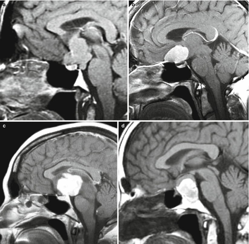 Tumors of Sellar and Parasellar Region Radiology Key