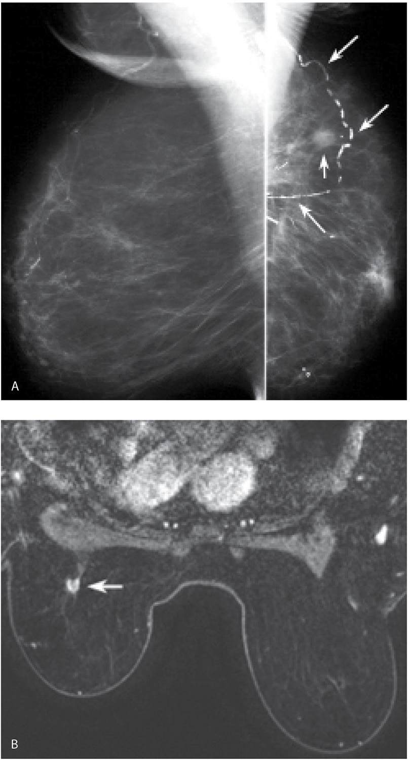 Evaluation and Imaging Features of Benign Breast Masses Radiology Key