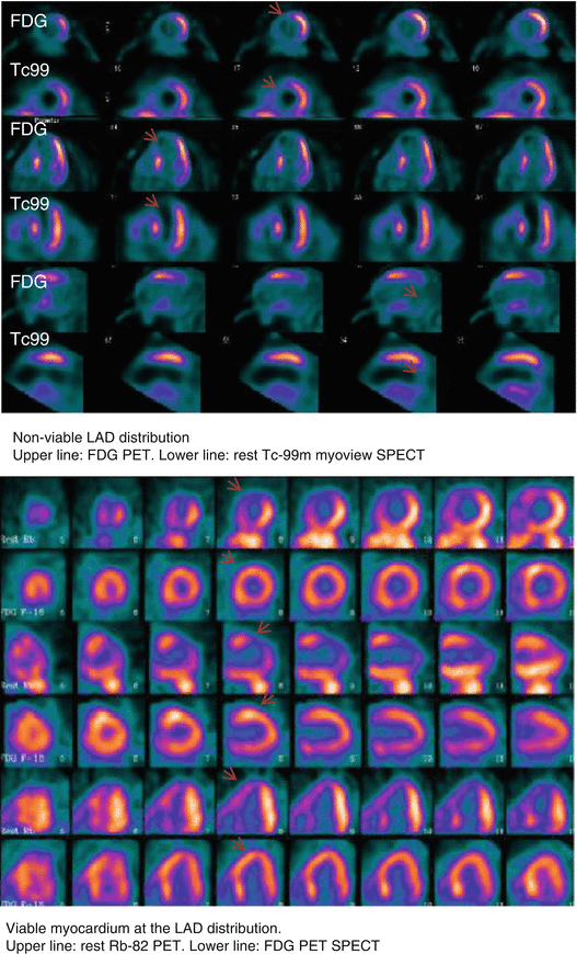 4 FDAApproved PET/CT Tracers Radiology Key