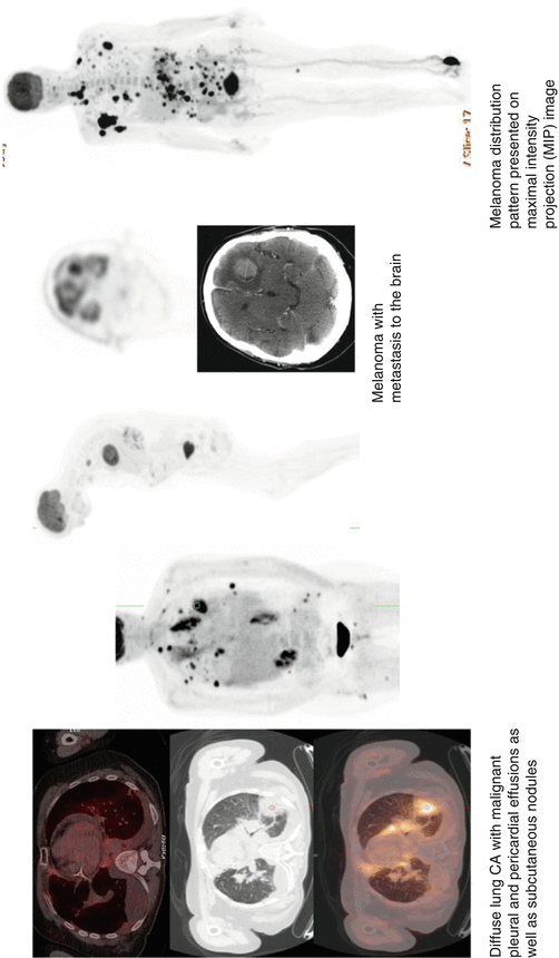 4 FDAApproved PET/CT Tracers Radiology Key