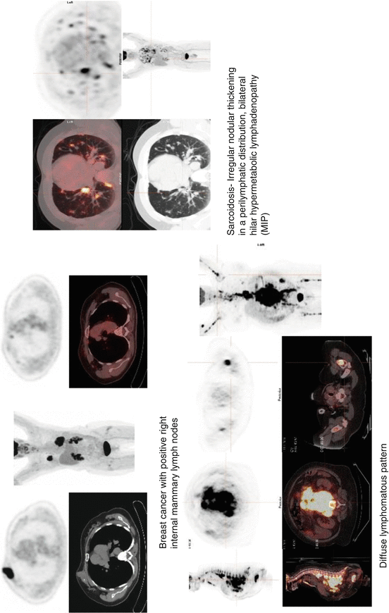 4 FDAApproved PET/CT Tracers Radiology Key
