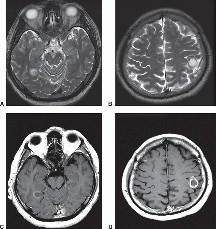 Brain Infections Radiology Key