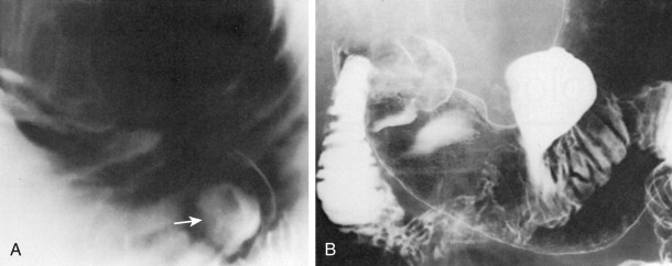 Barium Studies Single and Double Contrast Radiology Key