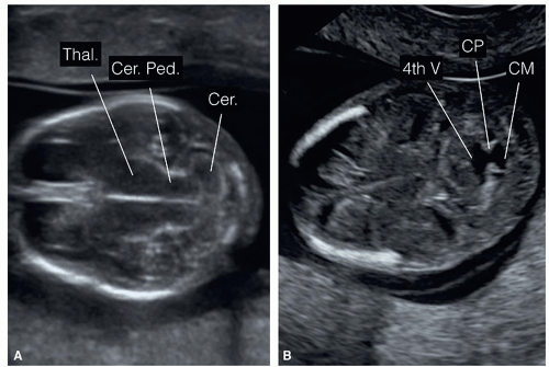 The Fetal Central Nervous System | Radiology Key