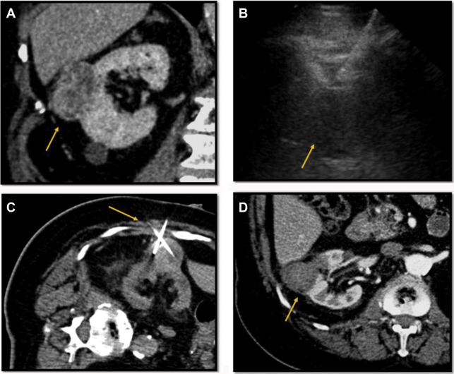 Percutaneous Thermal Ablation for Treatment of T1a Renal Cell