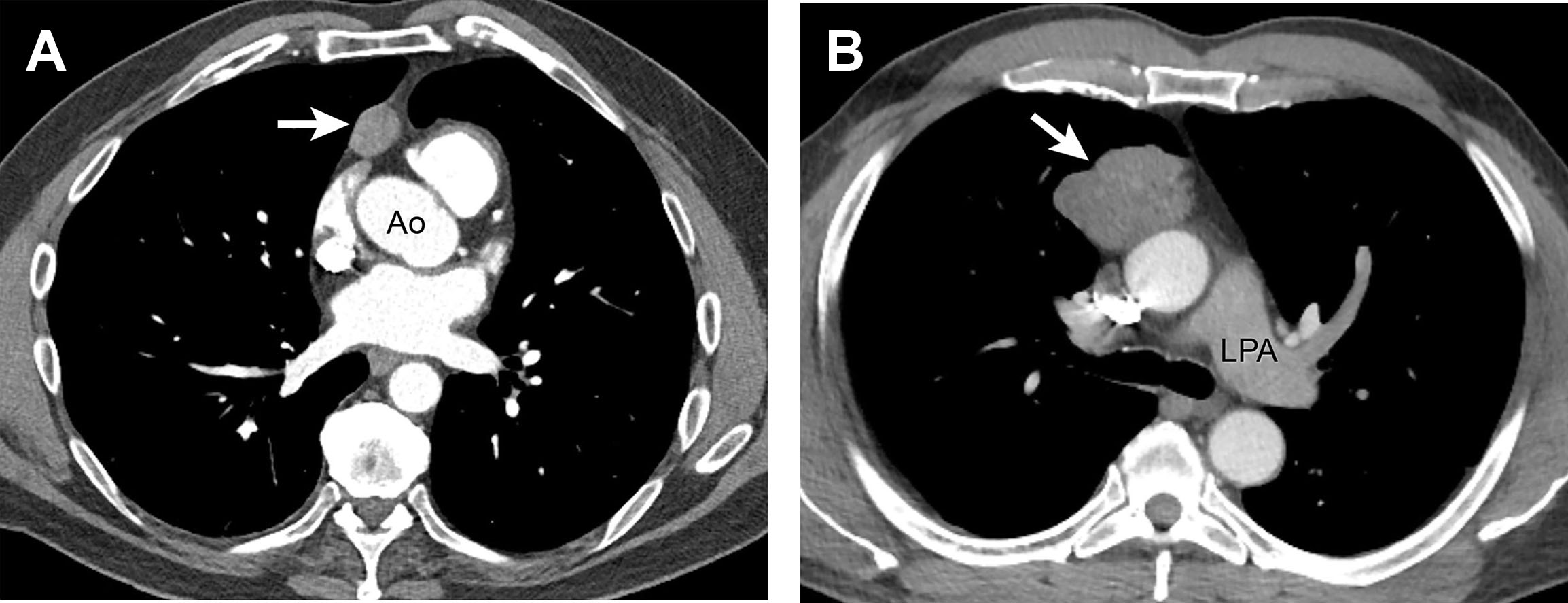 Thymic Epithelial Neoplasms Radiology Key