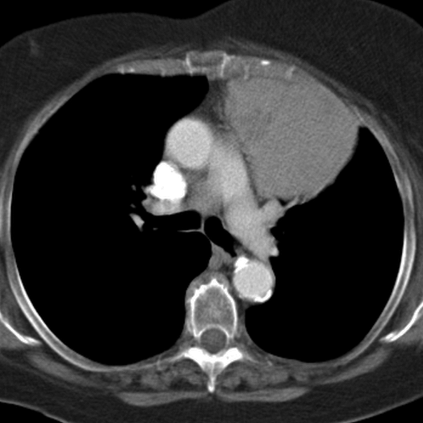 Imaging of the Anterior/Prevascular Mediastinum Radiology Key