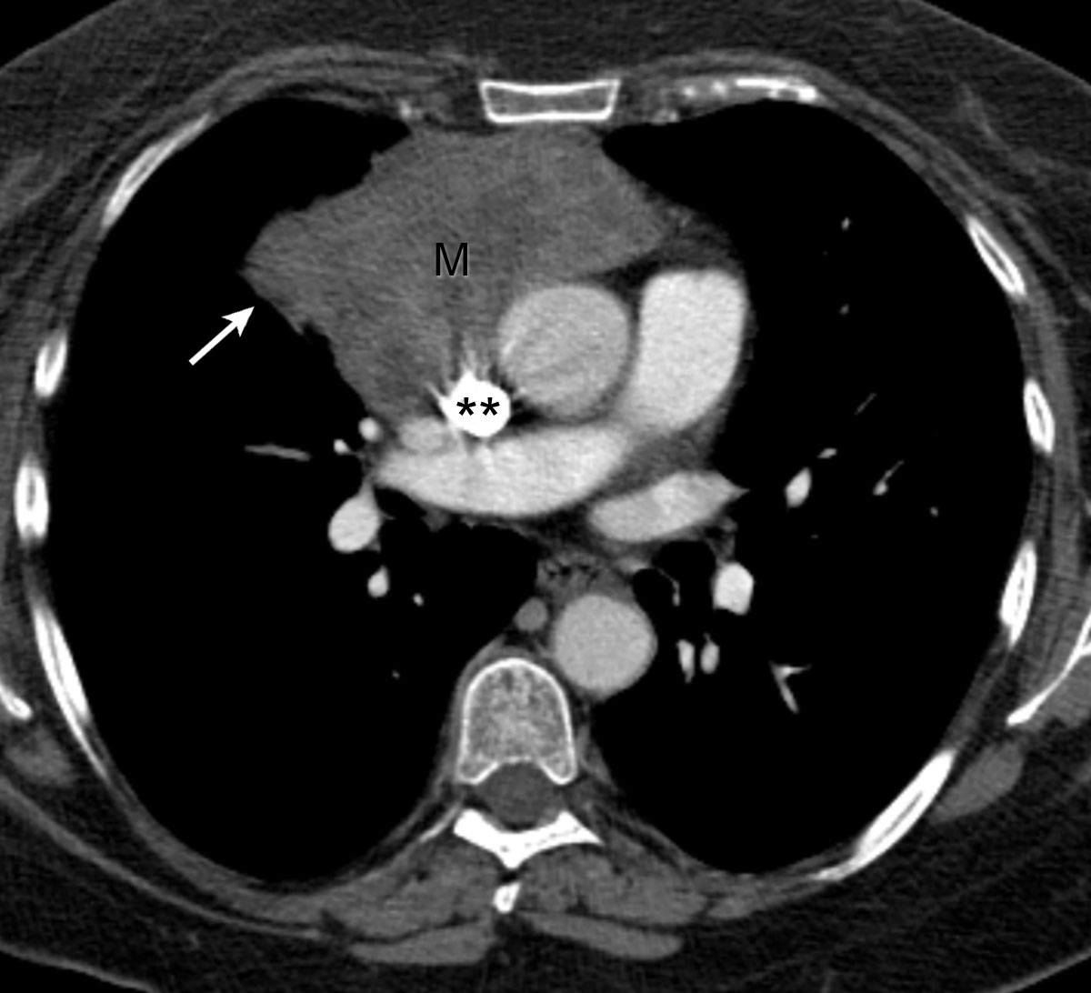 Thymic Epithelial Neoplasms Radiology Key