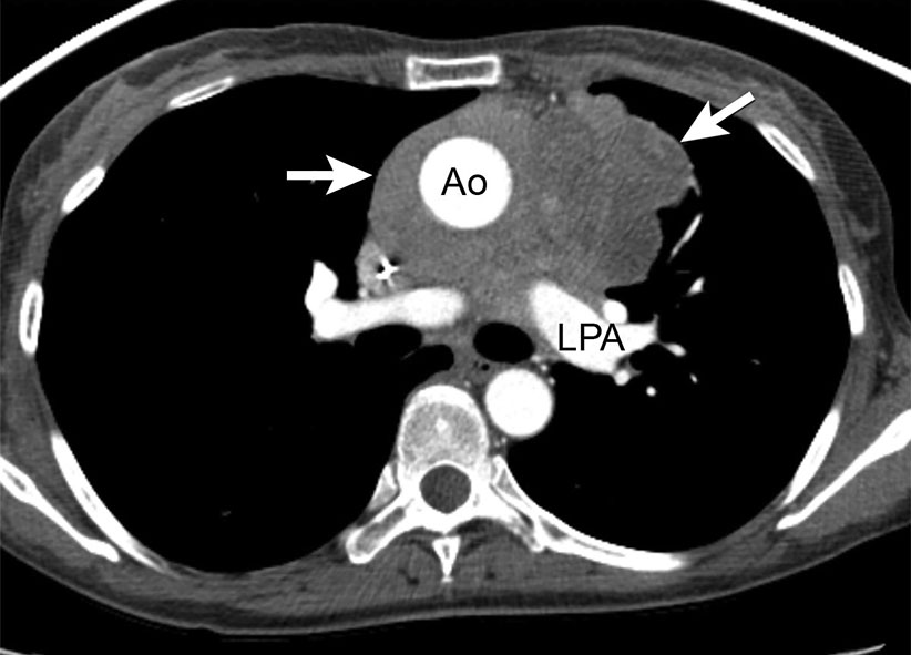 Thymic Epithelial Neoplasms Radiology Key