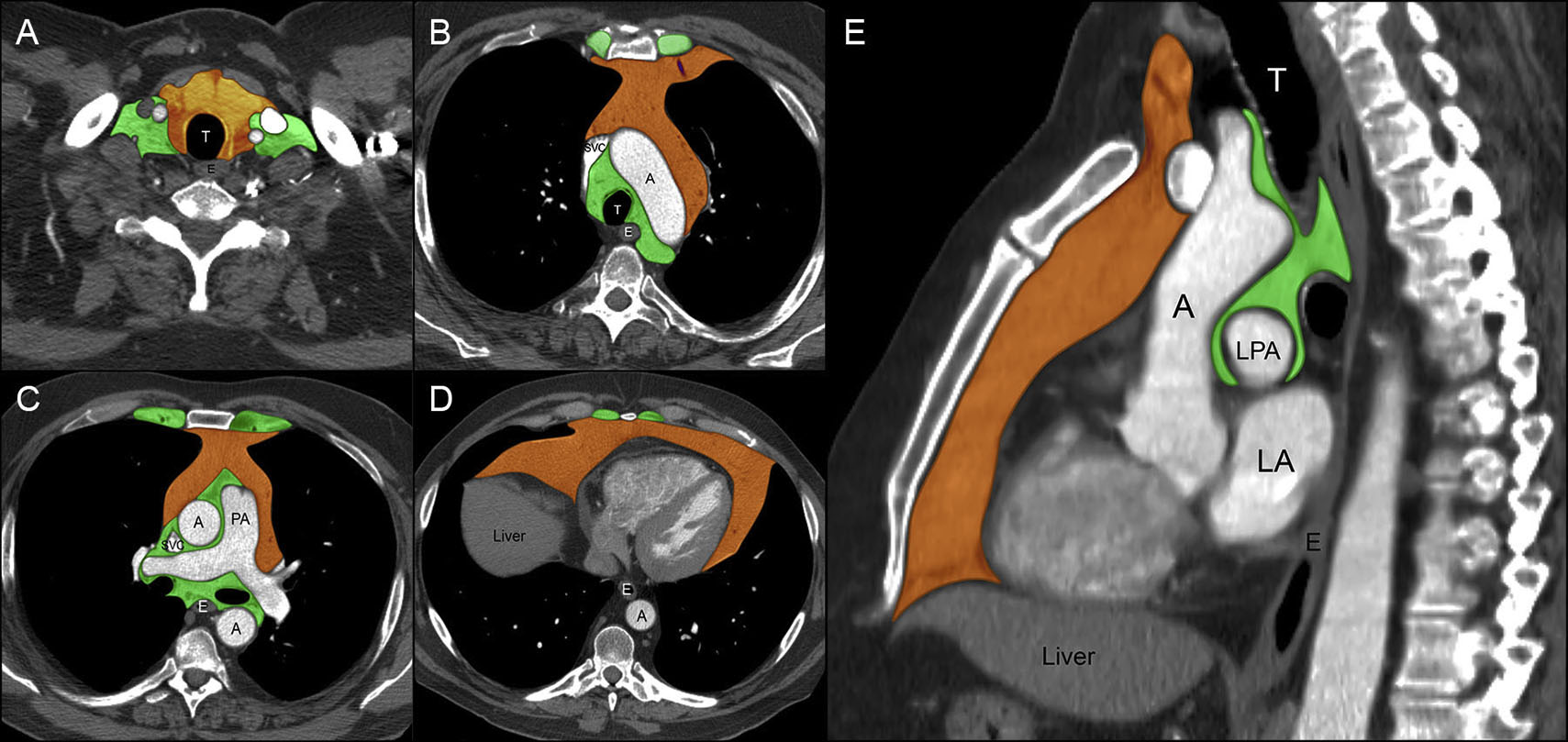 Thymic Epithelial Neoplasms Radiology Key
