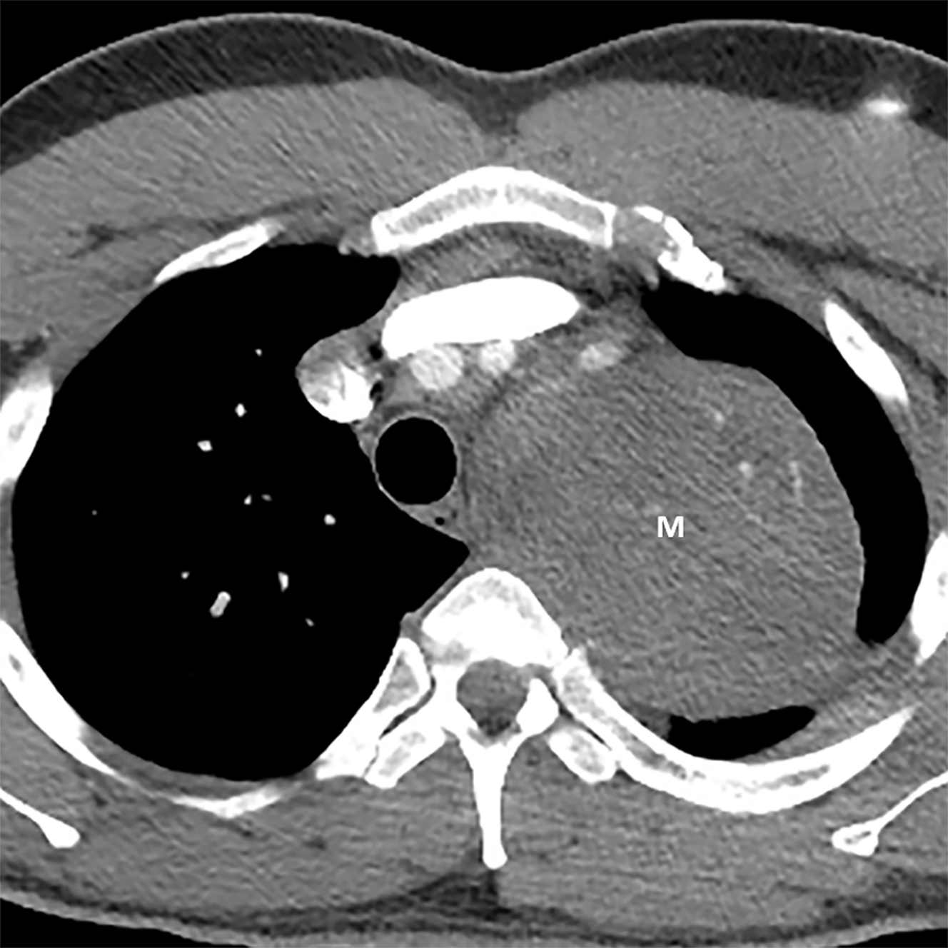 International Thymic Malignancy Interest Group Model of Mediastinal
