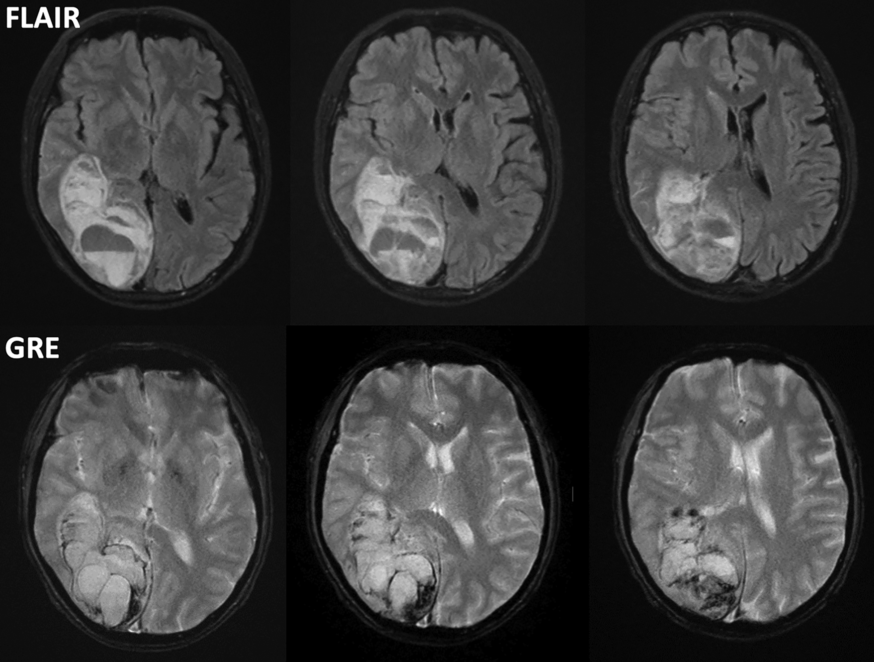 Acute Ischemic Stroke Radiology Key