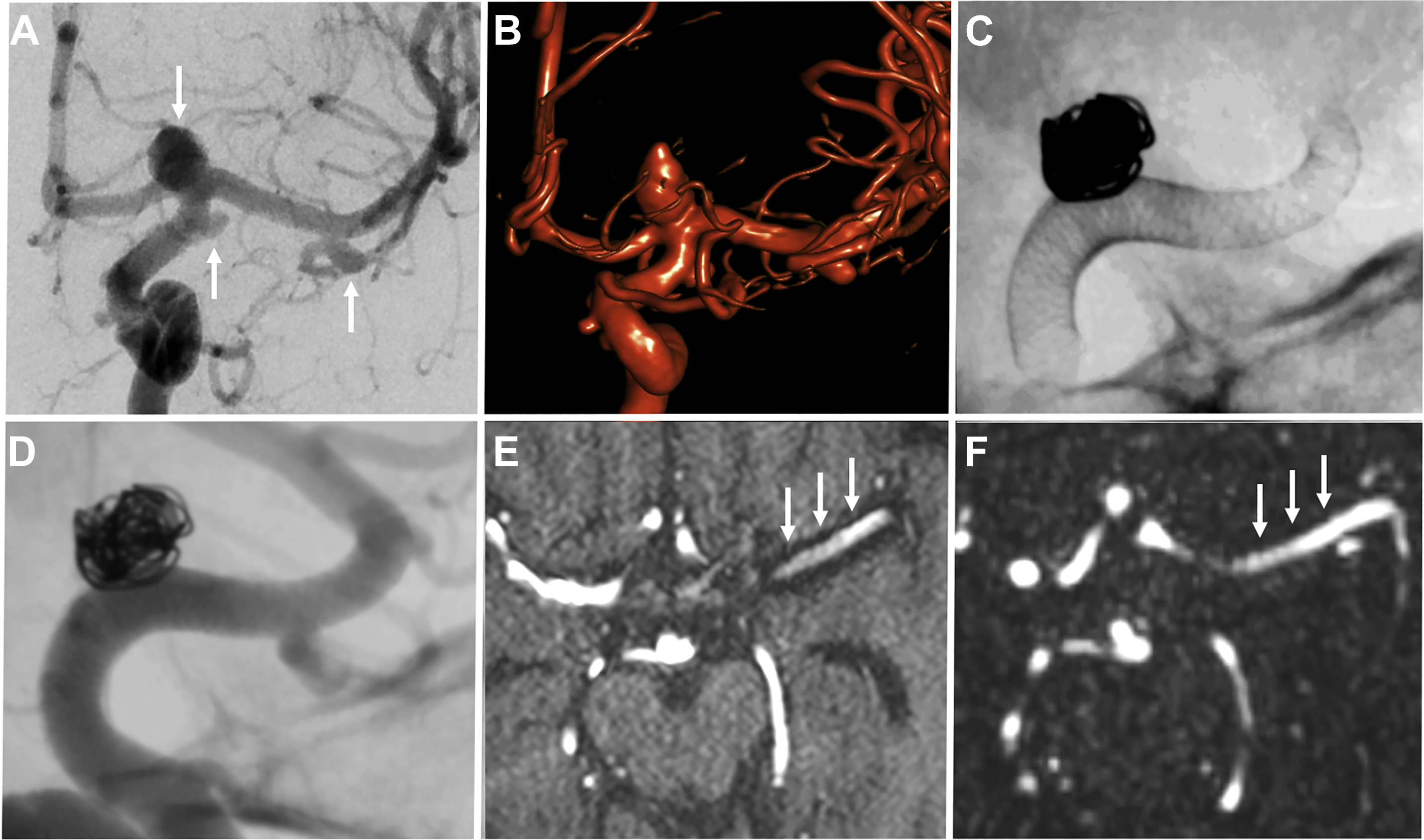 Imaging for Treated Aneurysms (Including Clipping, Coiling, Stents