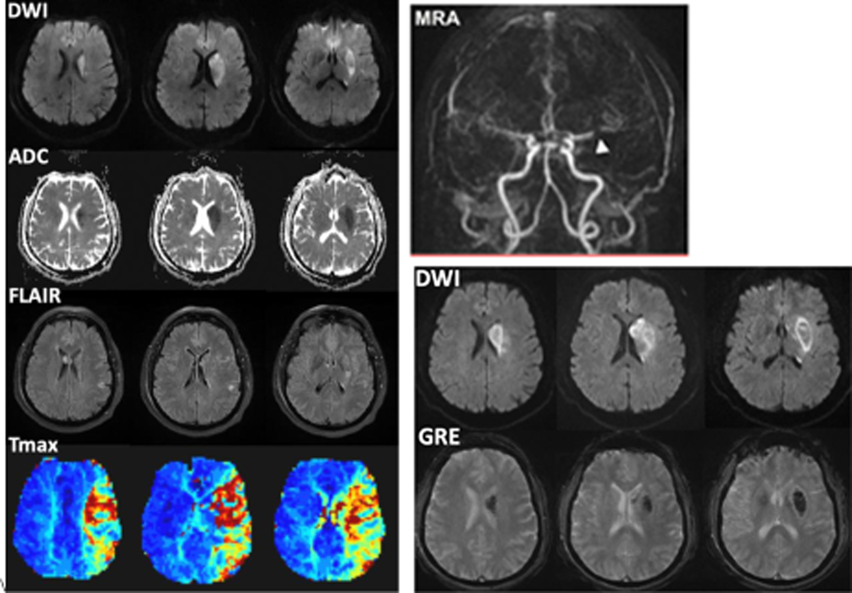Acute Ischemic Stroke Radiology Key