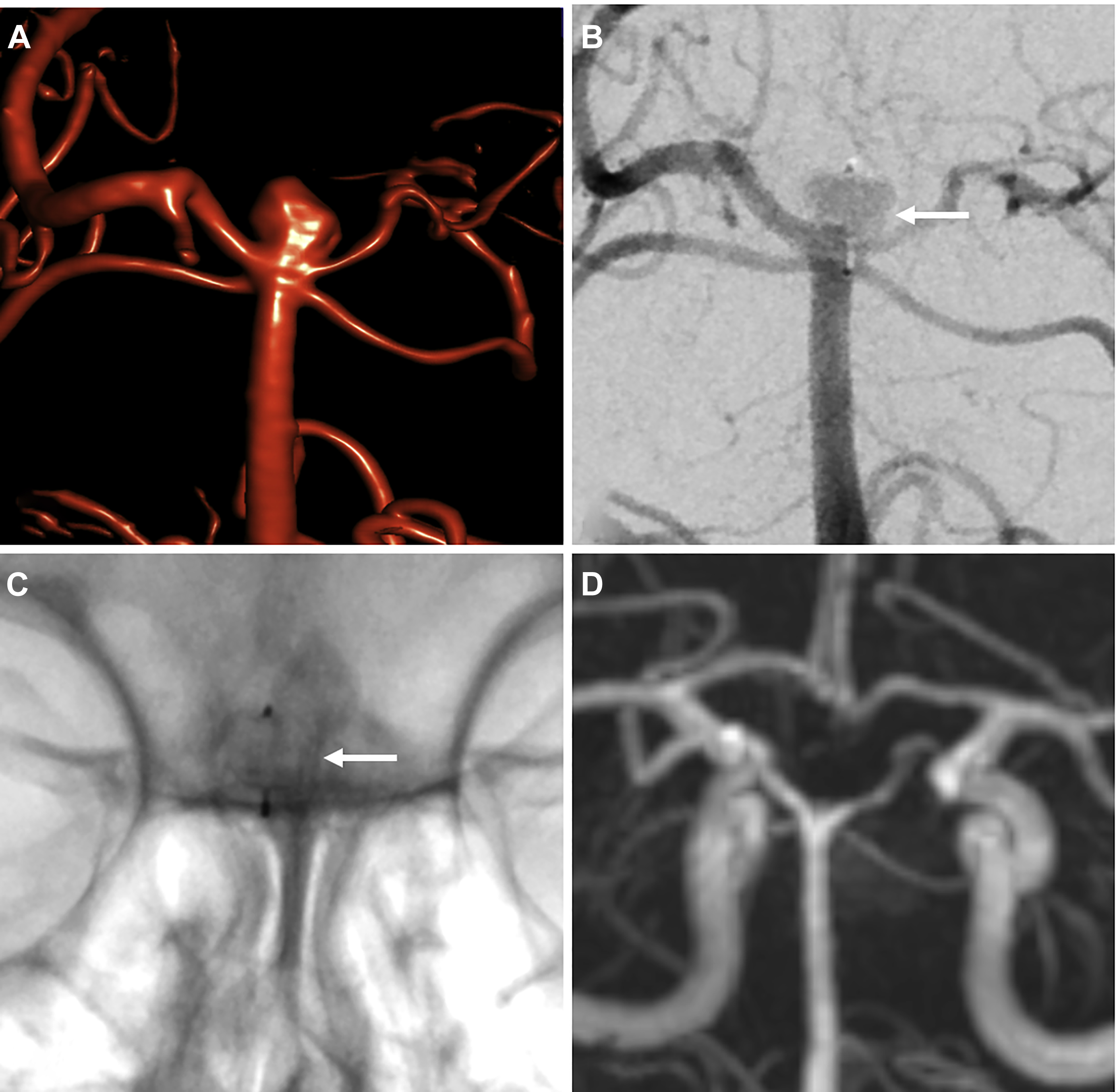 Imaging for Treated Aneurysms (Including Clipping, Coiling, Stents