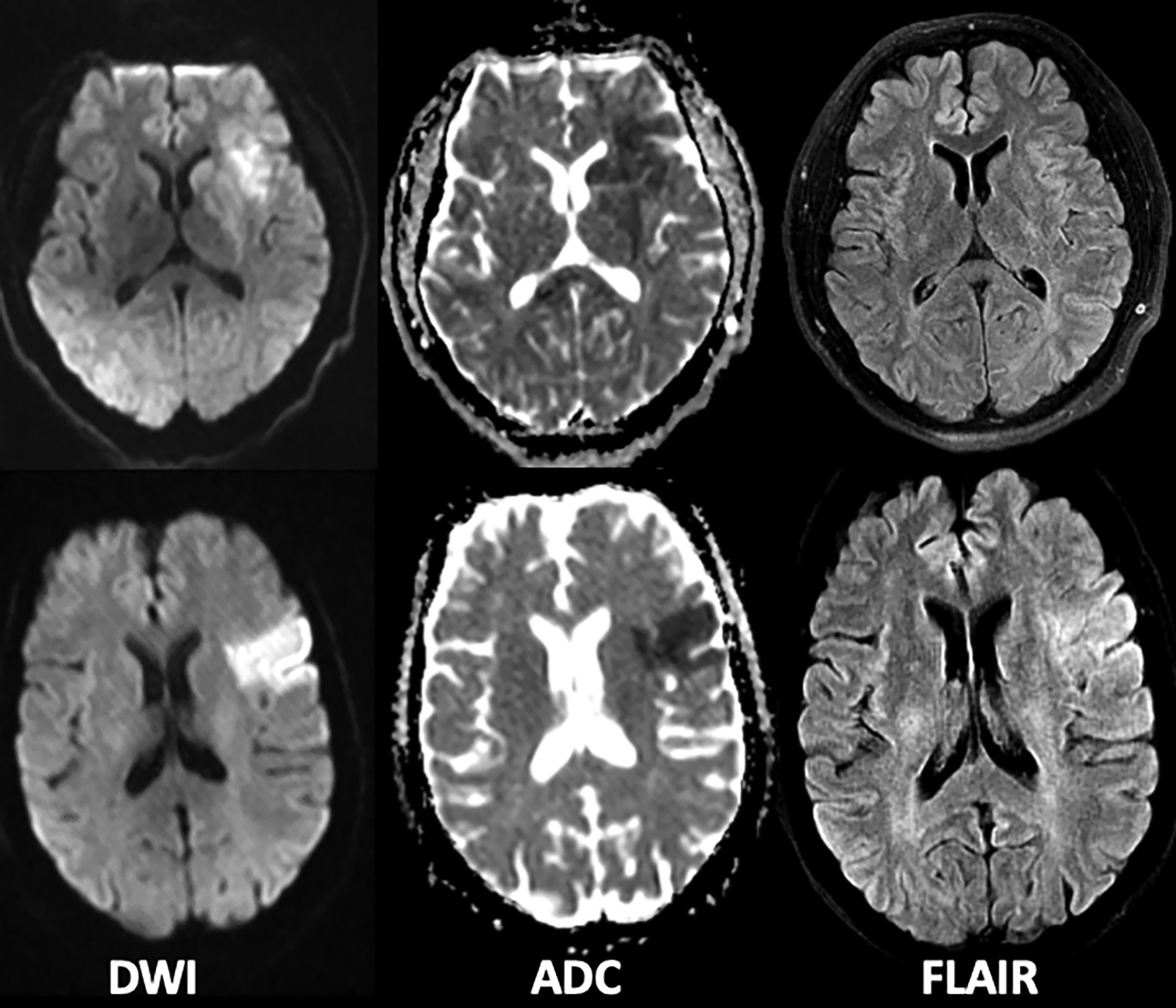 Acute Ischemic Stroke Radiology Key