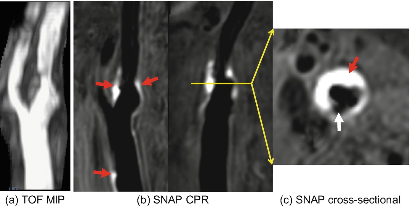 Carotid Vessel Wall Imaging and Future Directions Radiology Key