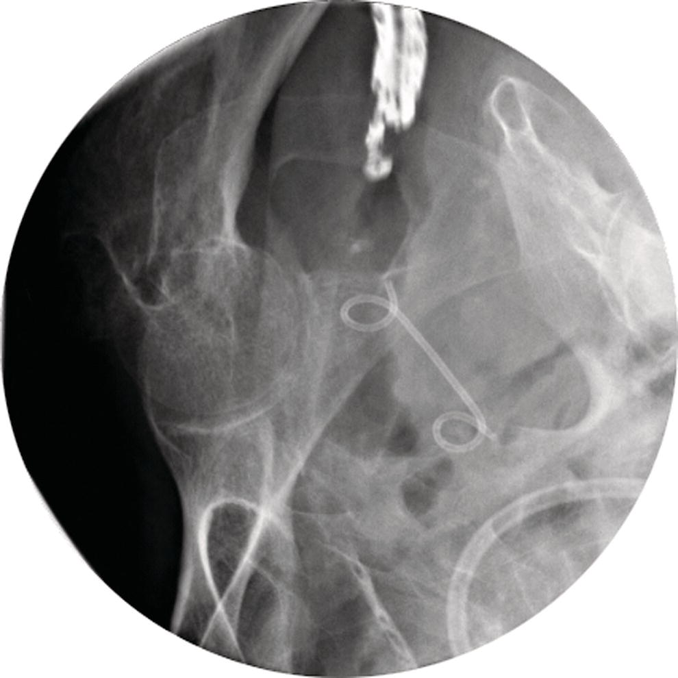 How to do EUS‐guided Pelvic Abscess Drainage Radiology Key
