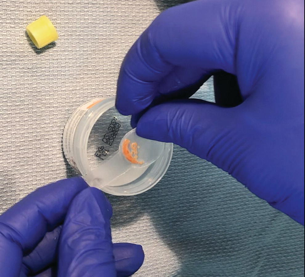 How to do Endoscopic Ultrasound‐guided Liver Biopsy Radiology Key