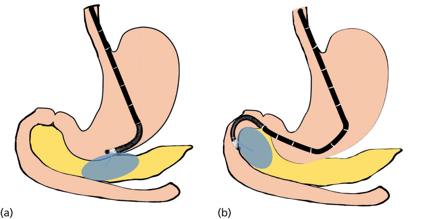 How to Perform Pancreatic Mass Fine Needle Biopsy Radiology Key