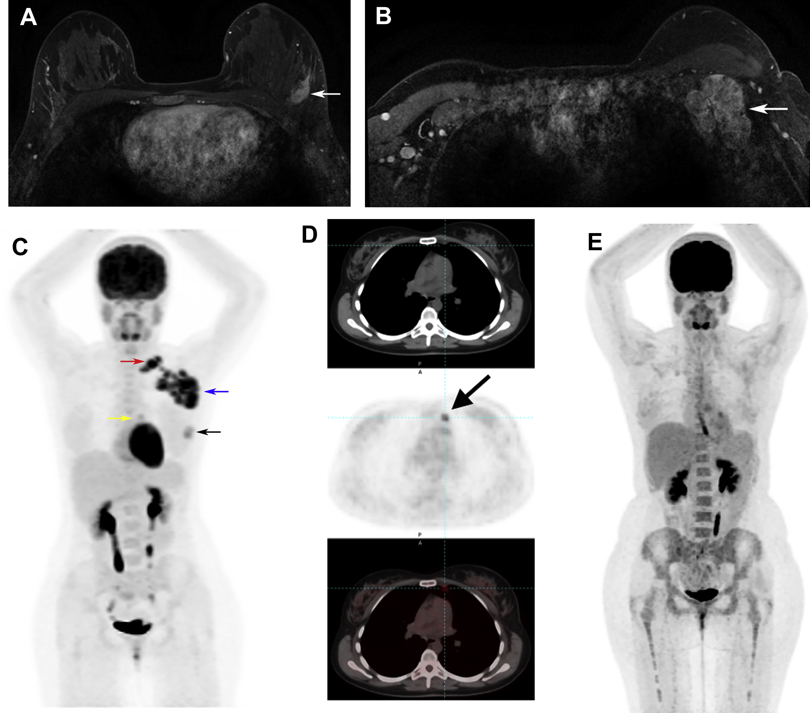 PET Imaging for Breast Cancer Radiology Key