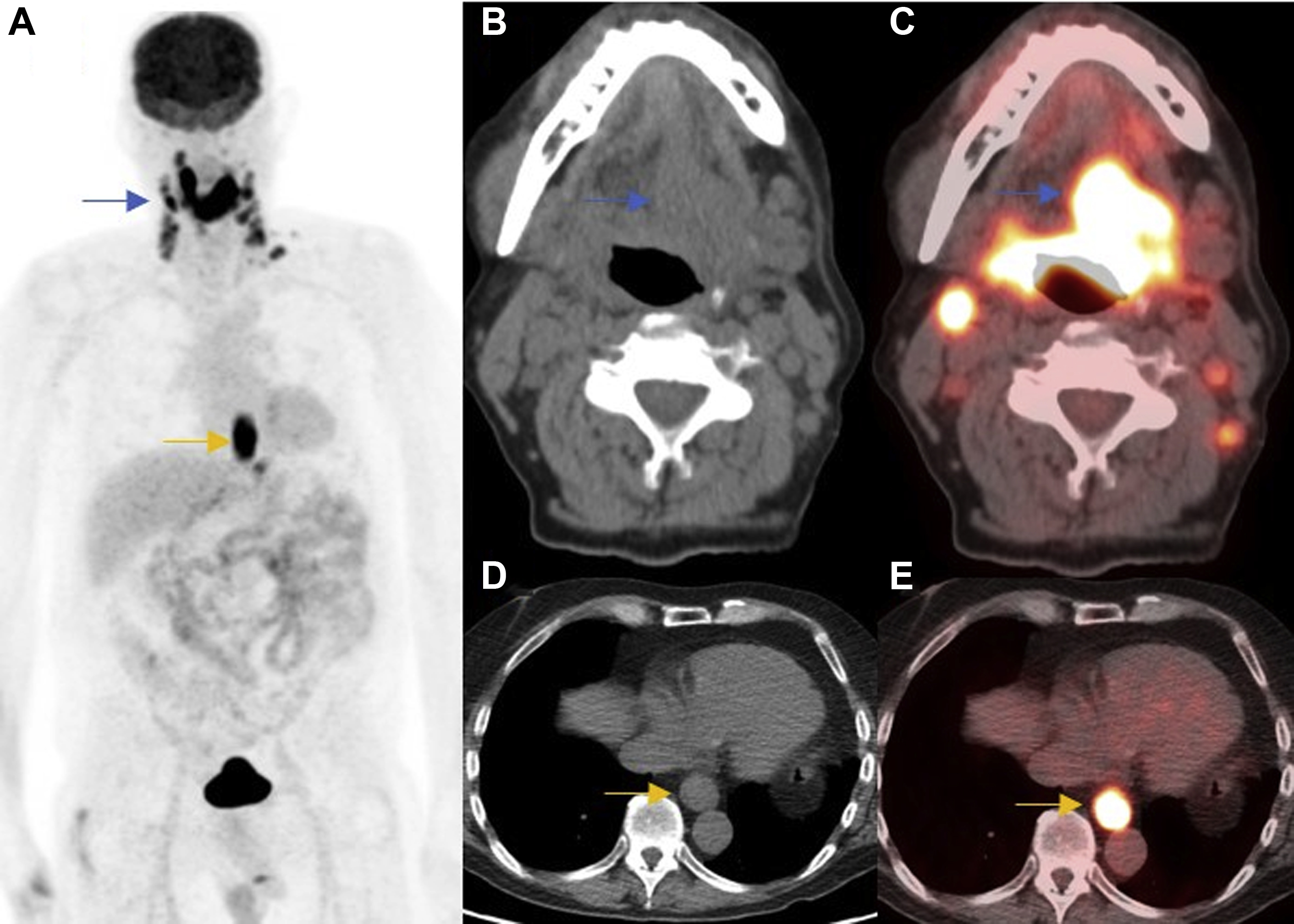 PET Imaging for Head and Neck Cancers Radiology Key