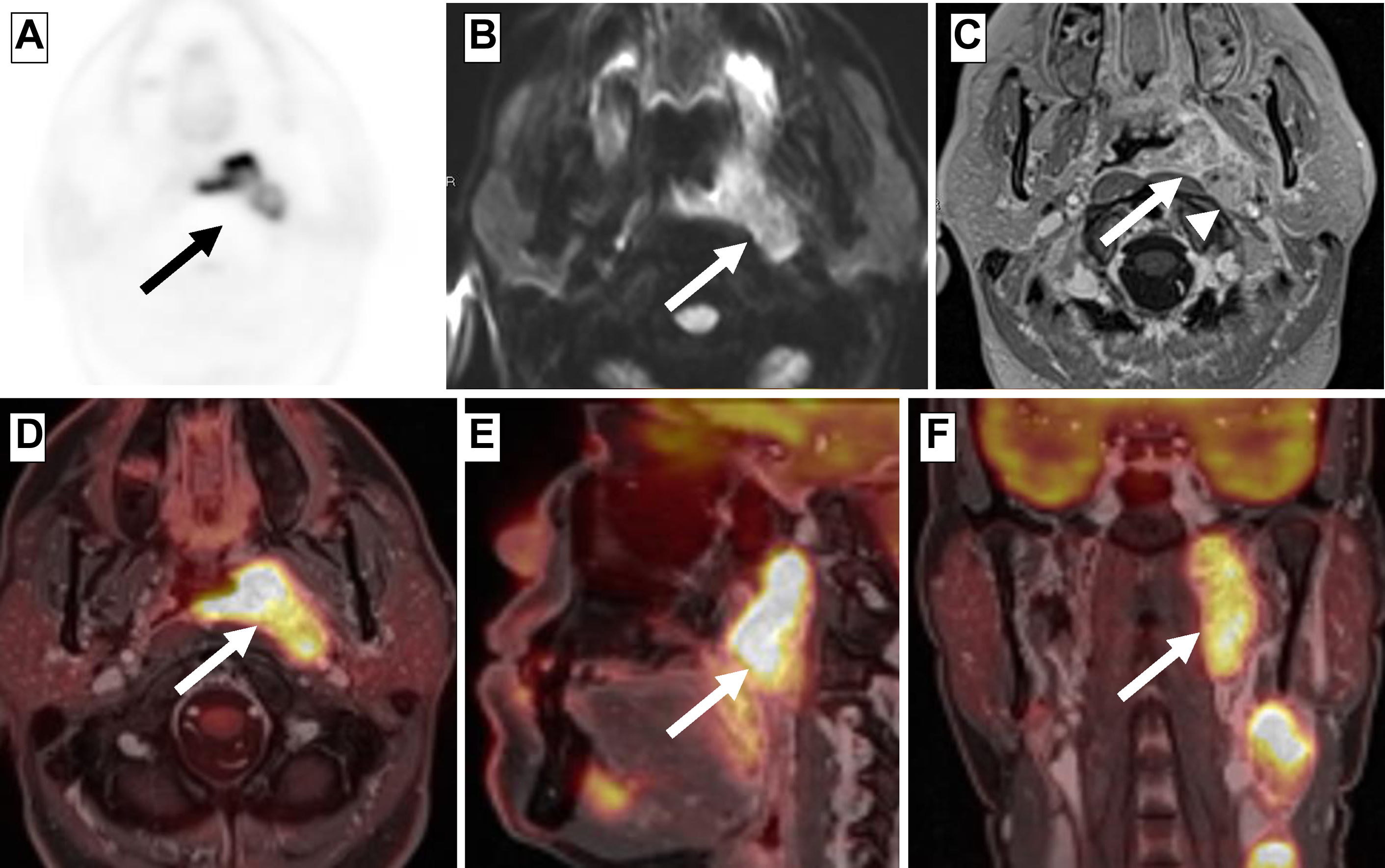 PET/CT and PET/MR Imaging of the Posttreatment Head and Neck Radiology Key