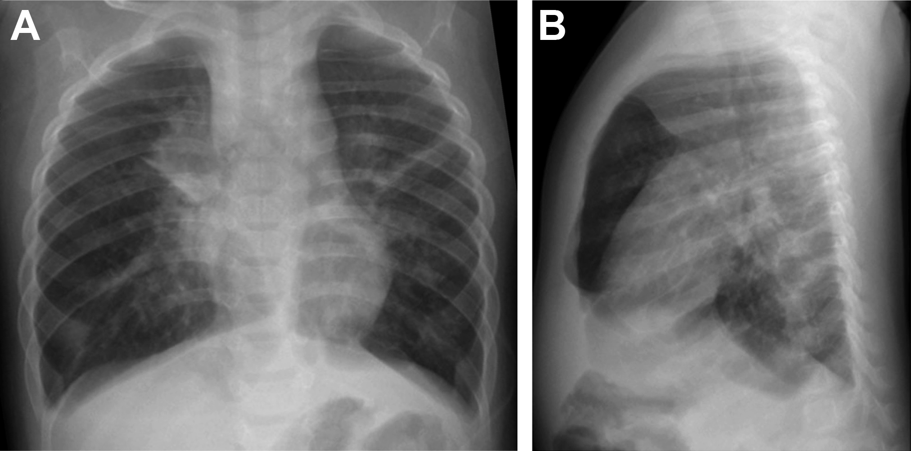 Pediatric Lower Respiratory Tract Infections Radiology Key