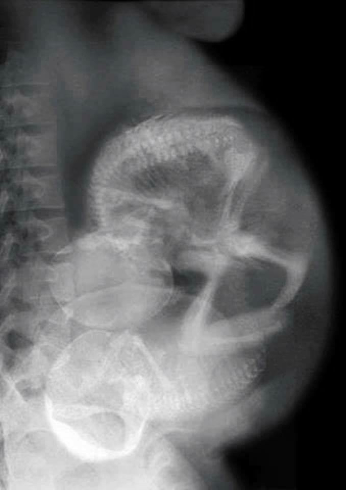 KUB Case of the day what is your diagnosis? radRounds Radiology