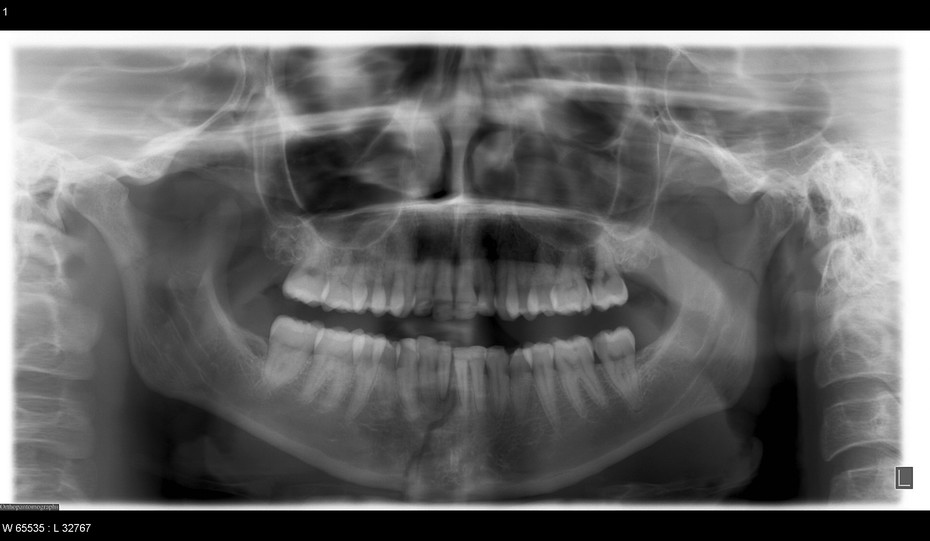 Mandible Fracture radRounds Radiology Network