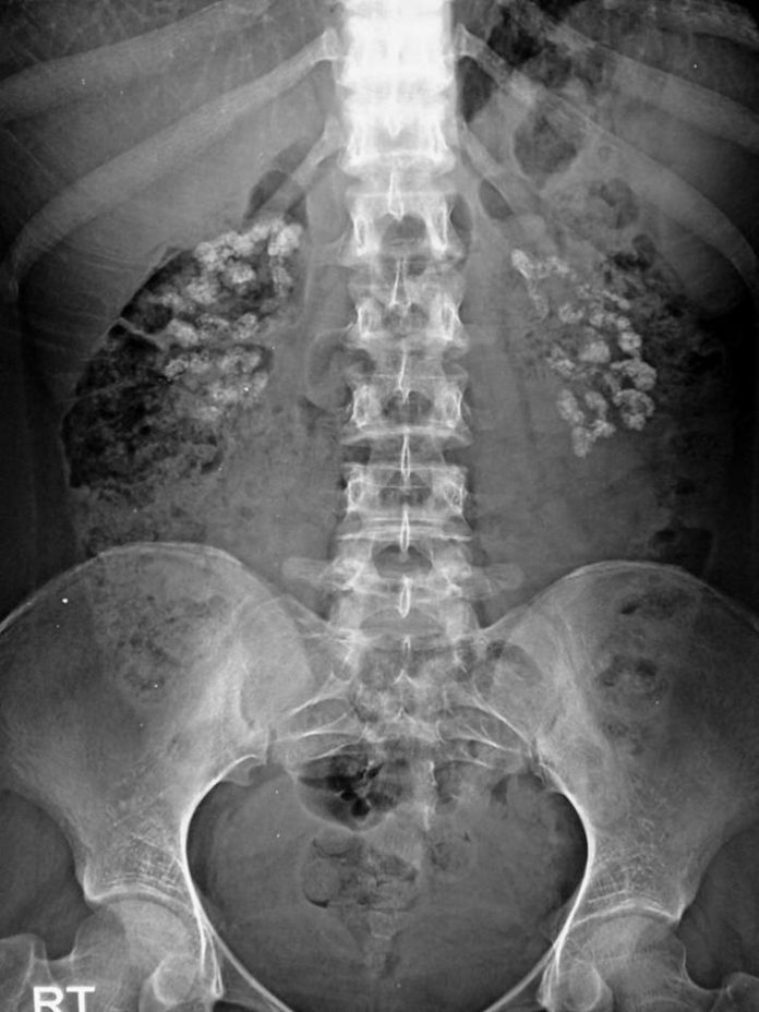 Medullary nephrocalcinosis radRounds Radiology Network