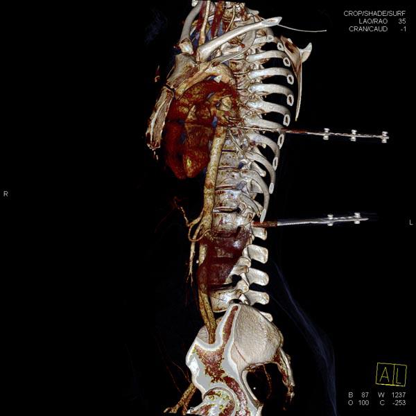 Trauma 2 knives in the back radRounds Radiology Network
