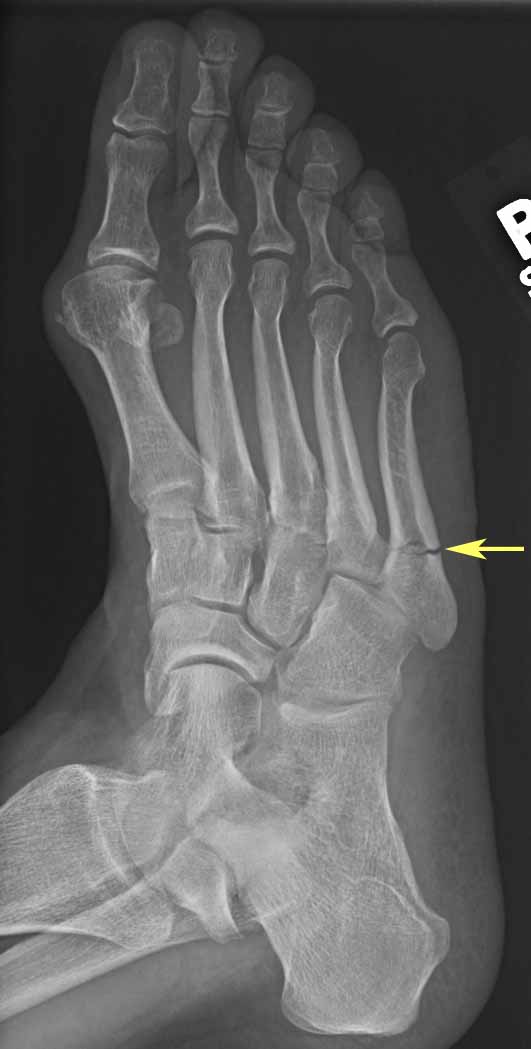 Jones Fracture (XRay) radRounds Radiology Network