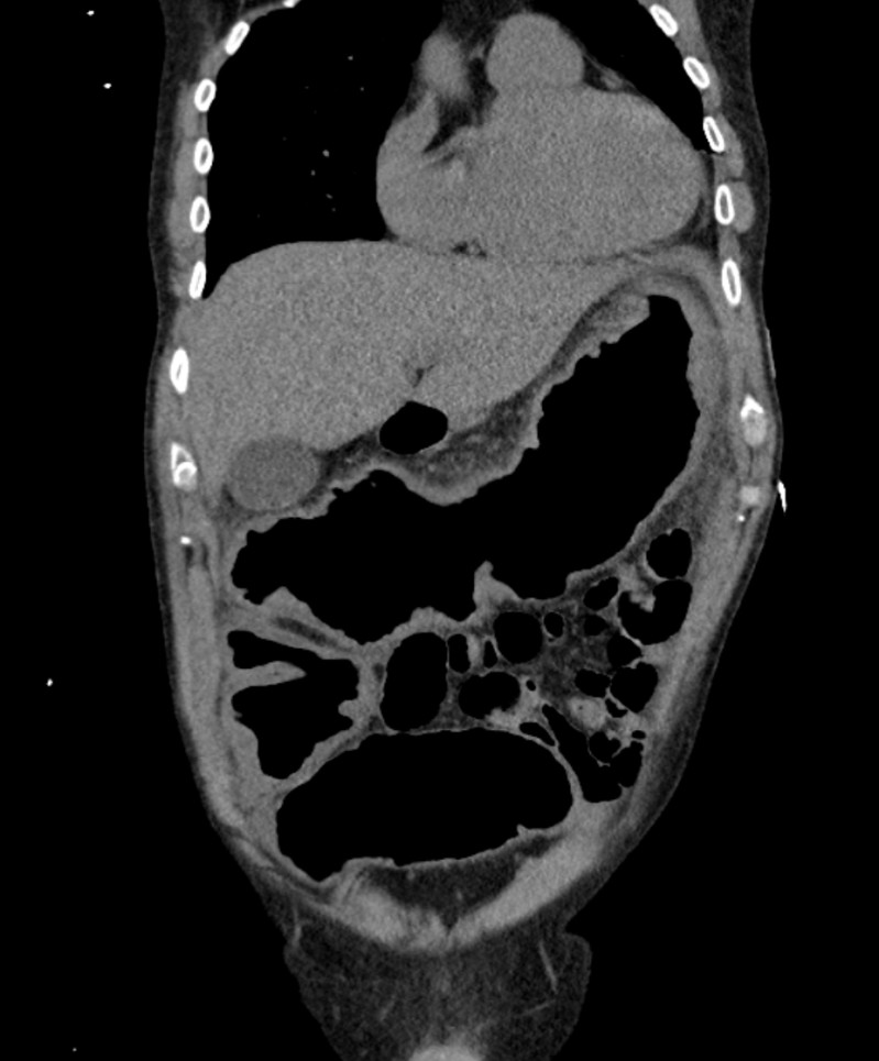Toxic megacolon Radiology Case