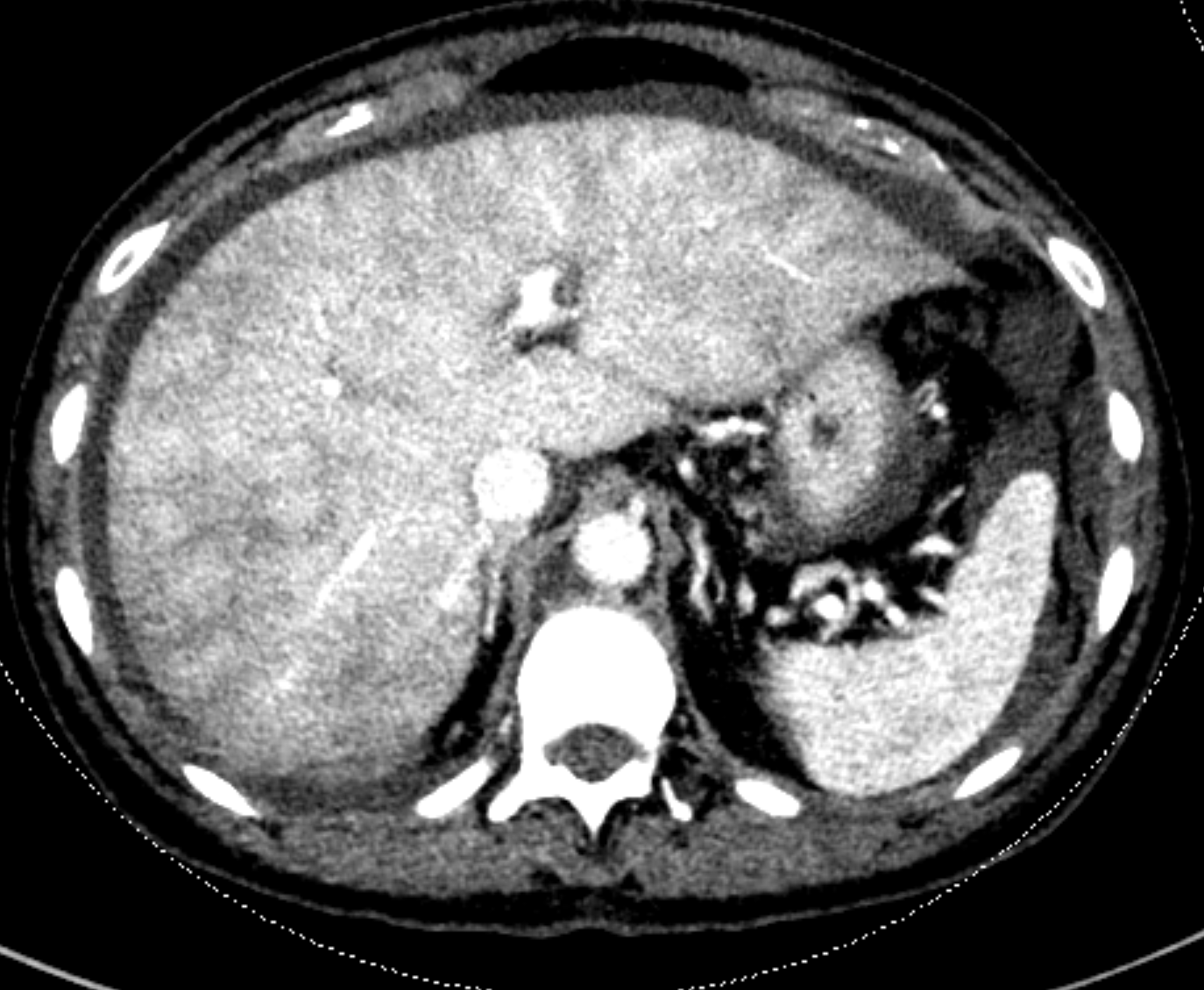 Passive hepatic congestion Radiology Case