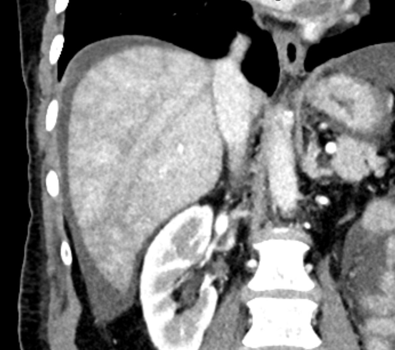 Passive hepatic congestion Radiology Case
