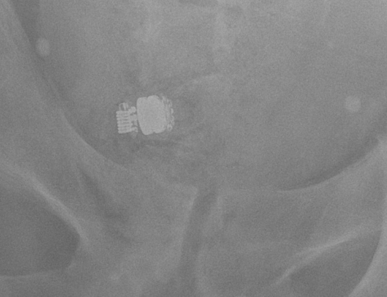 Video endoscopy capsule Xray Radiology Case