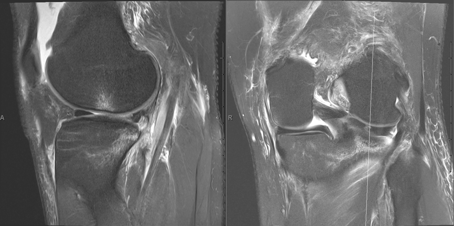 ACL tear Radiology Case
