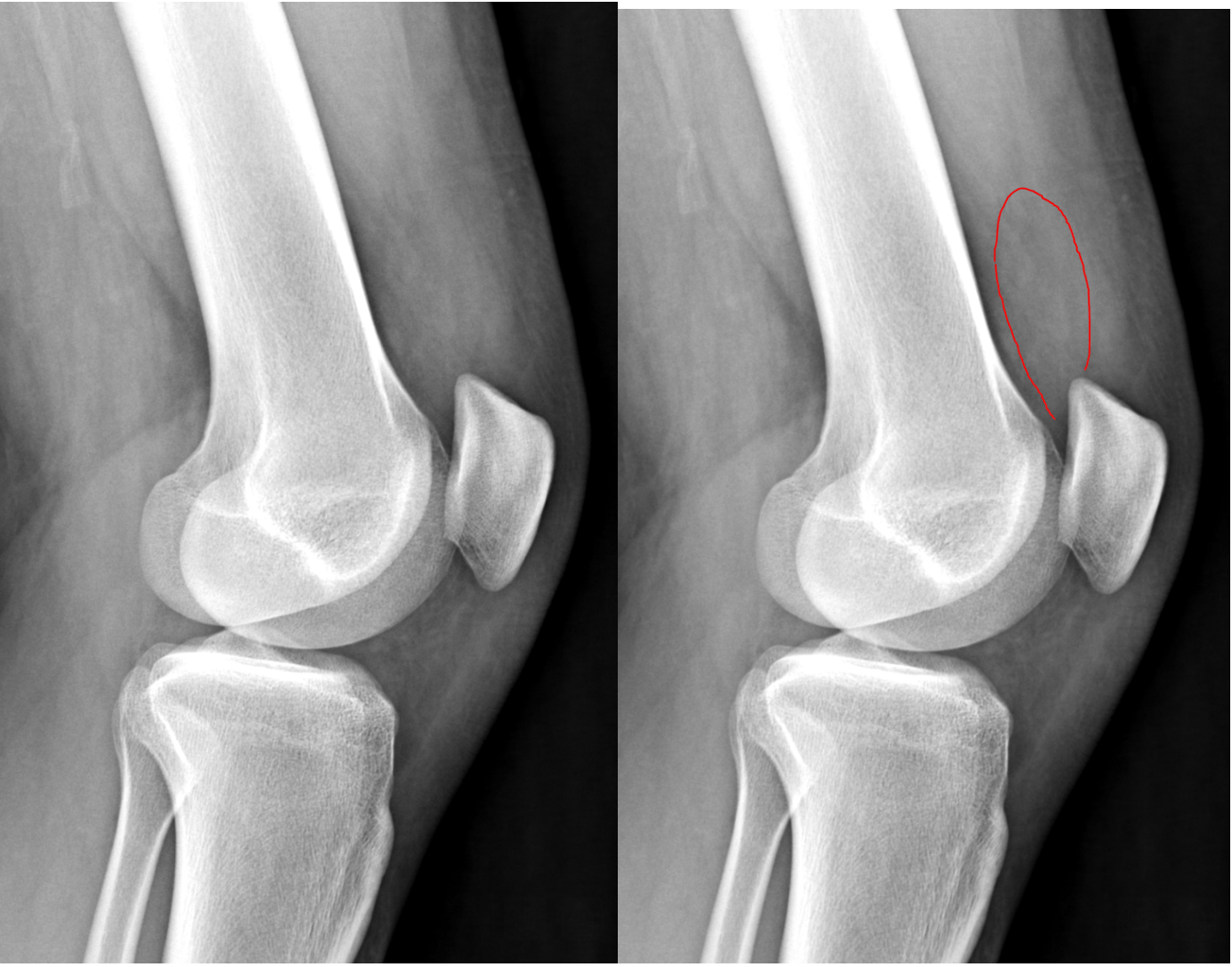 Knee Joint Effusions Radiology Article