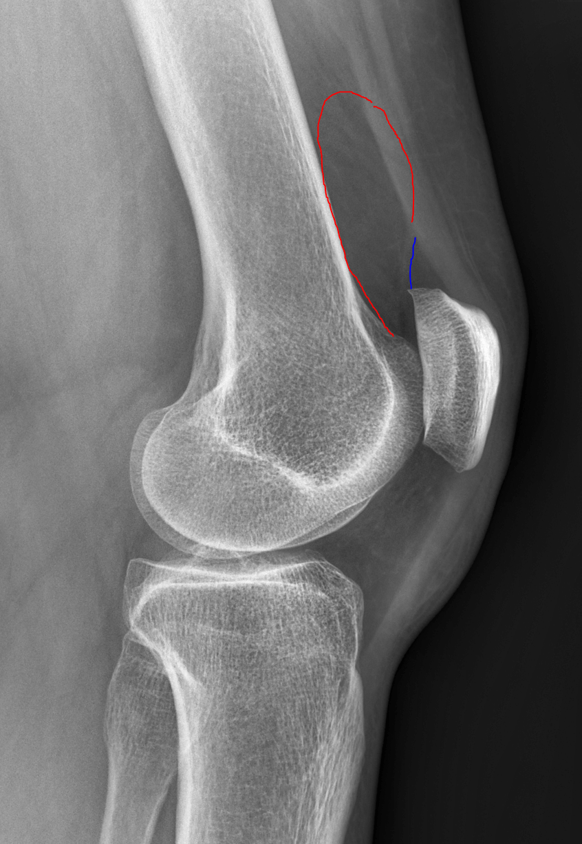Knee Joint Effusions Radiology Article