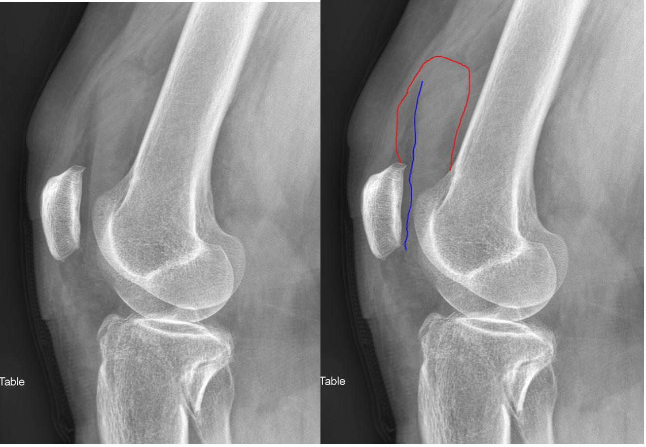 Knee Joint Effusions Radiology Article