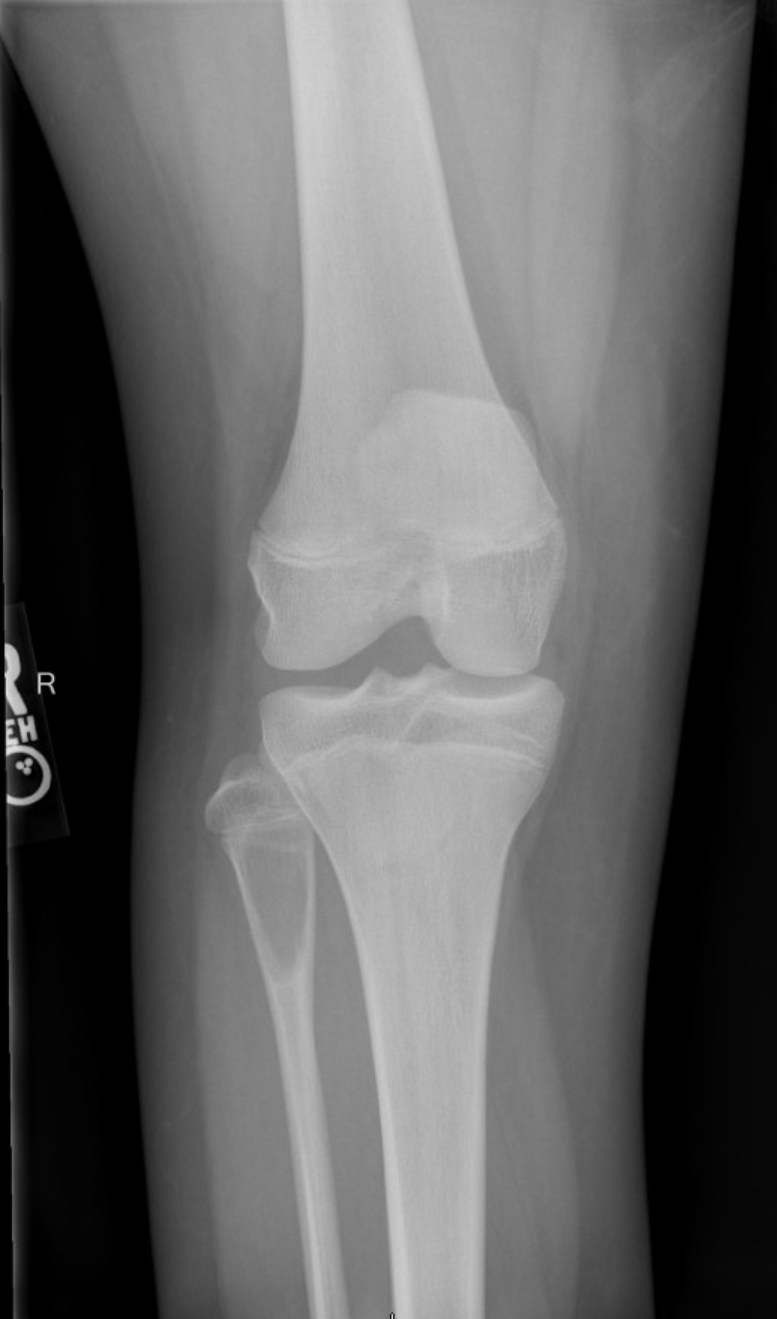 Aneurysmal bone cyst Radiology Case