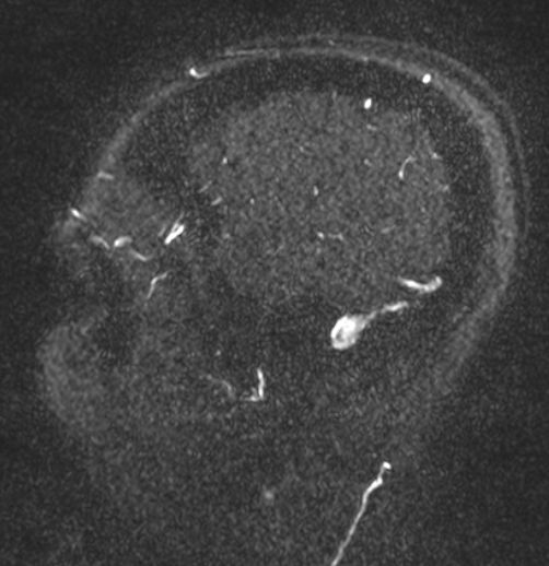 Idiopathic intracranial hypertension Radiology Case