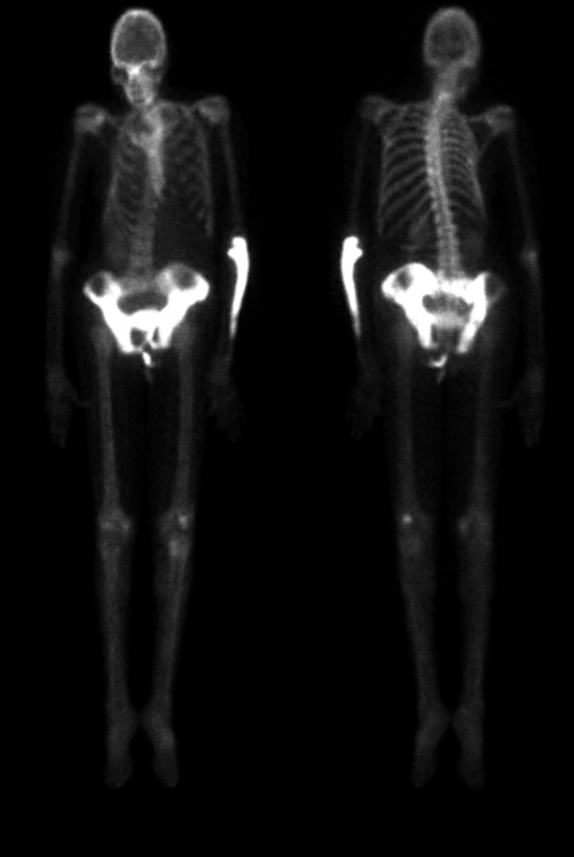 Paget disease bone scan Radiology Case
