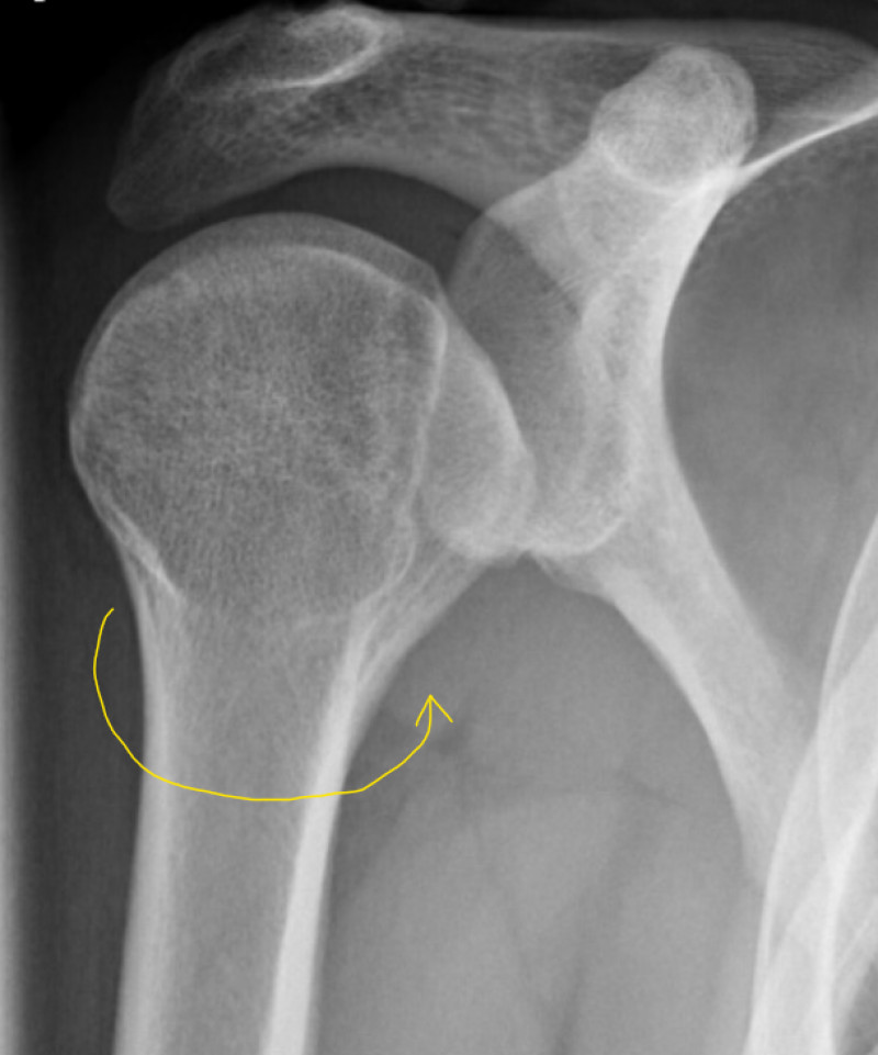 Posterior shoulder dislocation and reverse HillSachs Radiology Case