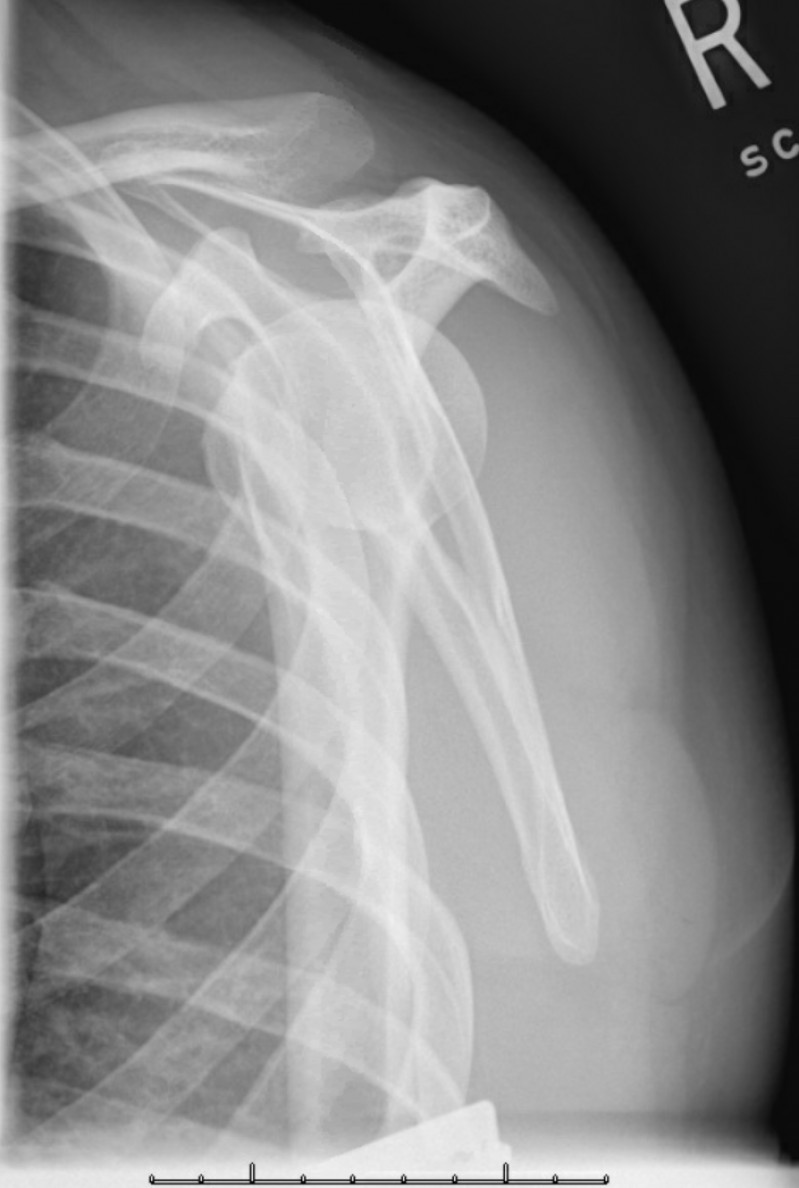 Posterior shoulder dislocation and reverse HillSachs Radiology Case