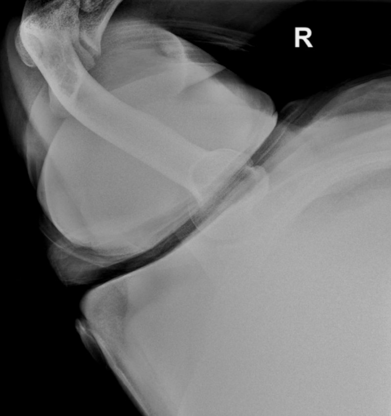 Posterior shoulder dislocation and reverse HillSachs Radiology Case