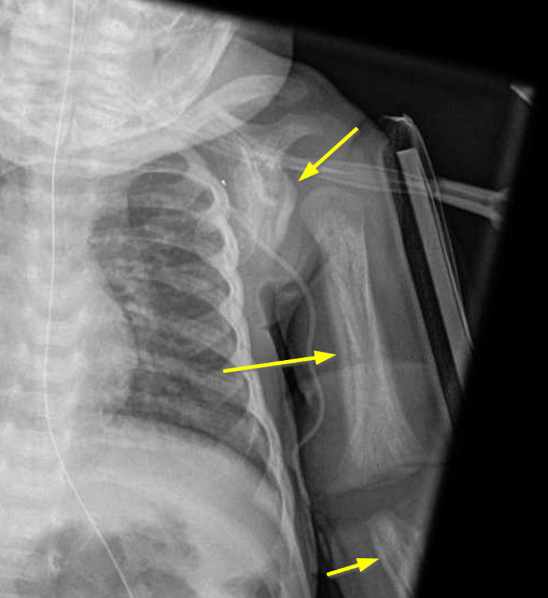 Prostaglandin periostitis Radiology Case